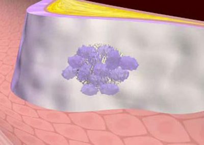 Acute Coronary Syndrome: Medical Animation