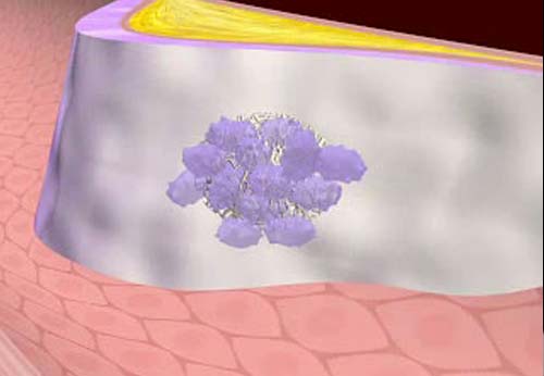 Acute Coronary Syndrome: Medical Animation